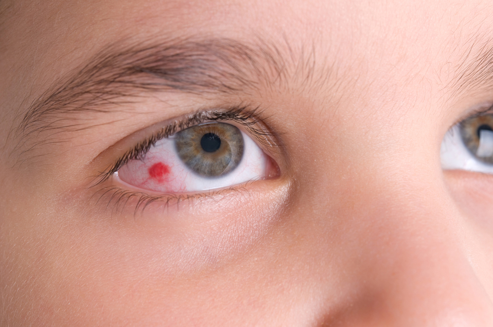 Can you wear contacts with broken blood vessel in eye Burst Blood Vessel Optometrist In Houston Eye Site
